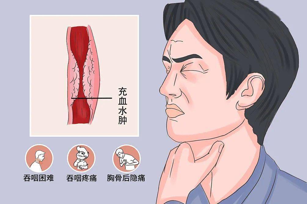 谈癌论健 | 放射性食管炎,了解一下?_放疗