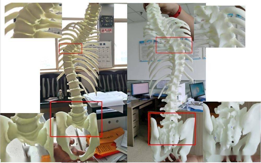 術前術後對比術前術後對比(術後脊柱側彎角度,骨盆傾斜明顯改善,雙側