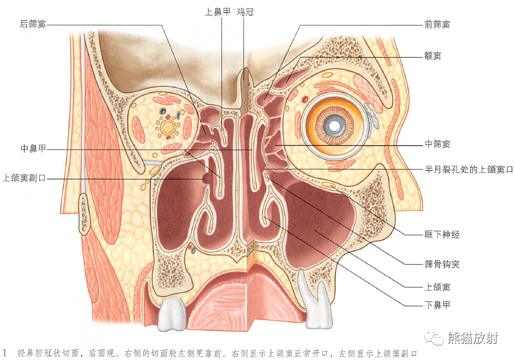 窦口鼻道复合体图片