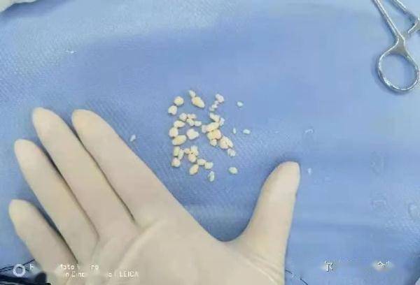 关节|肩关节中长出40多个“关节鼠” 医生微创端“鼠”窝