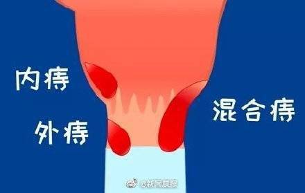 血液|蹲坑玩手机易成有痔青年