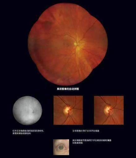 國際|國際先進眼底相機系統在哈醫大四院投用