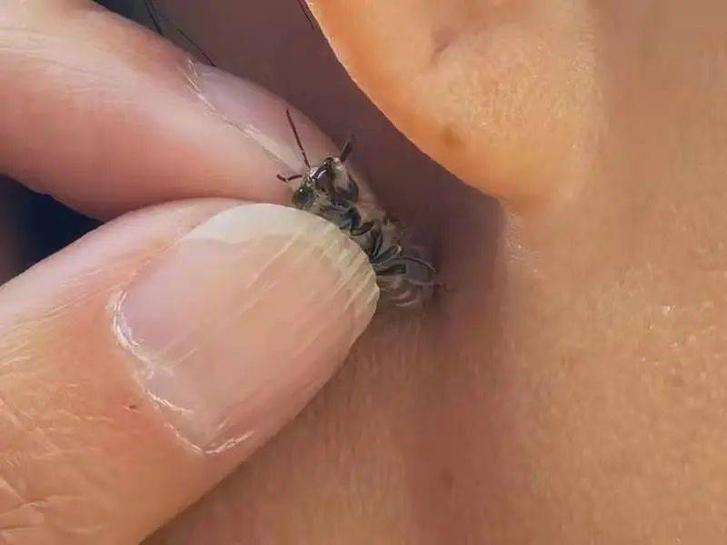 蜂针疗法语言中枢神经受损后的一个真实案例