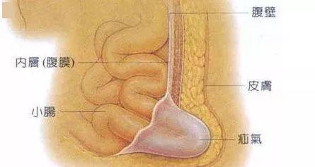 疝气的种类图片大全图片