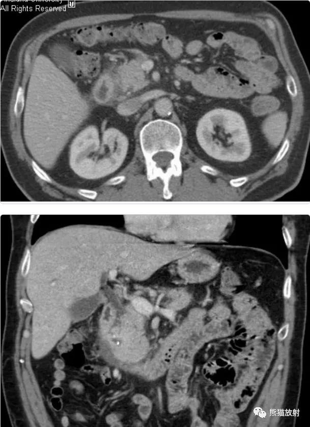 实质|沟槽区胰腺炎丨临床及影像表现