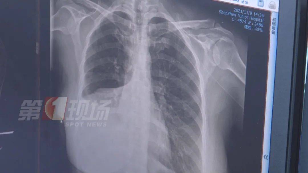 肿瘤|女子手指肿成“萝卜头”，一查竟是癌症！出现这些信号请务必警惕