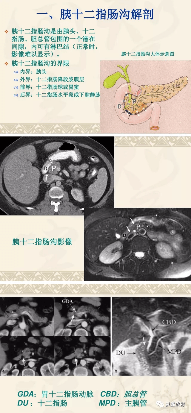 实质|沟槽区胰腺炎丨临床及影像表现