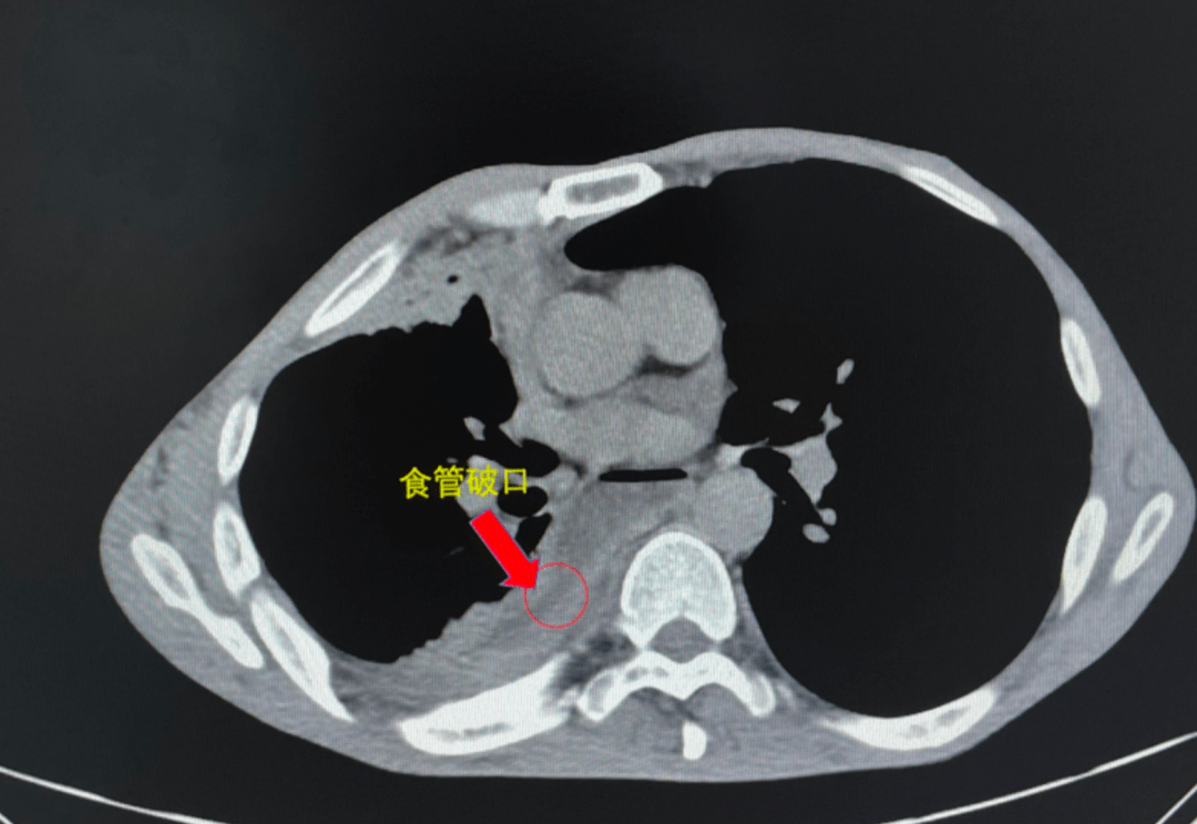 喝酒导致食管破裂?