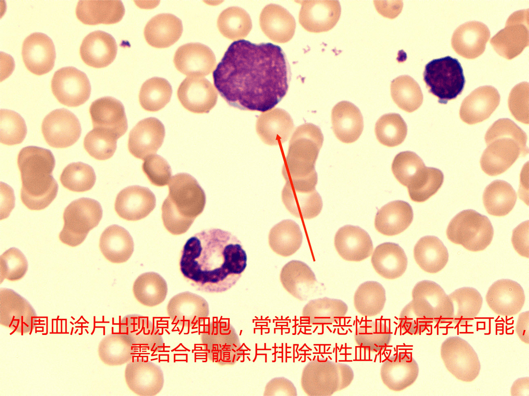 2,观察白细胞形态学改变,主要有数量的改变,中性粒细胞出现核左移和右