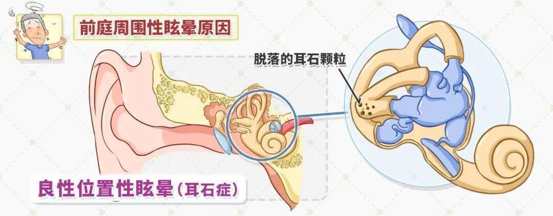 另一種常見的疾病耳石症,又稱 良性位置性眩暈,同樣也會導致眩暈.