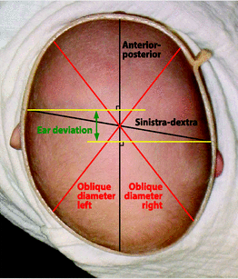 畸形_婴儿_头颅