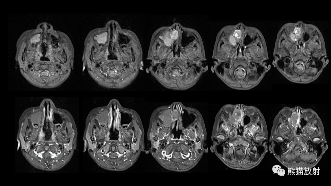鼻窦癌,颅面骨骨化性纤维瘤你想到了吗?有收获吗?