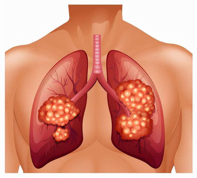 肺结节有什么症状图片