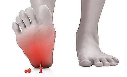 足底筋膜炎的5大原因6项康复运动