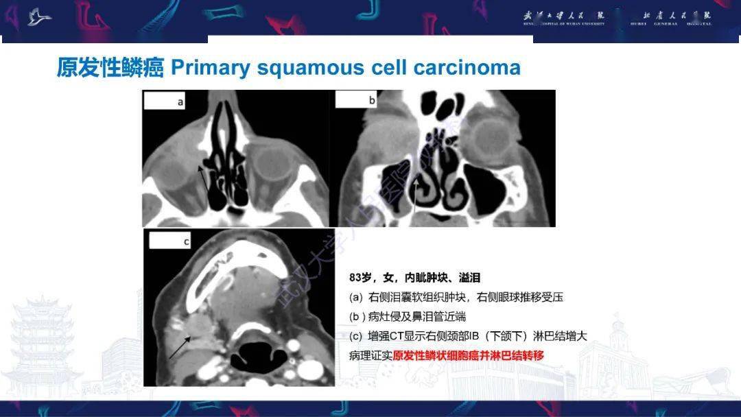 淚道病變影像診斷_全網_解剖圖_系統