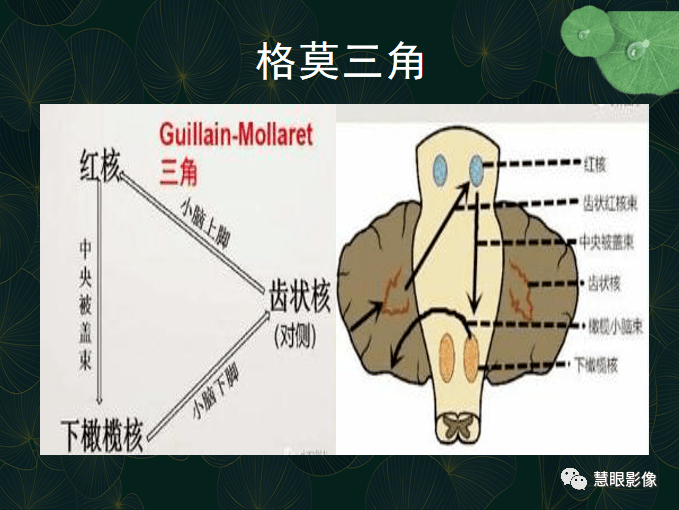 下橄榄核肥大变性图片