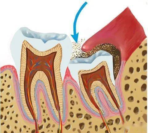 告别"痛苦面具"微创拔牙其实可以很easy_智齿_生齿_时间