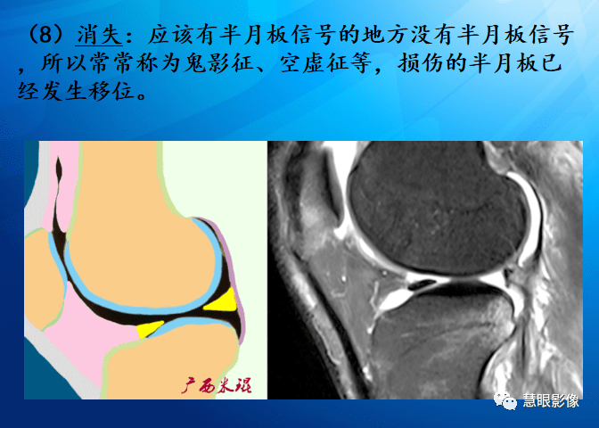 mri半月板損傷基礎