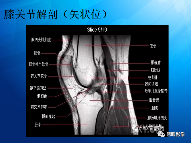 mri半月板损伤基础