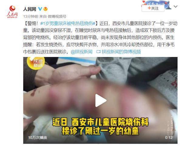 部位|警惕！1岁男童因没穿尿不湿 尿床后被电热毯烧伤