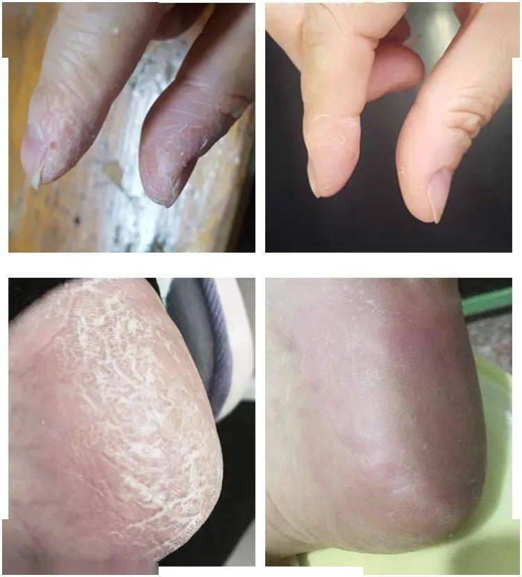 草本植物脚跟开裂、老茧、死皮……又疼又丑！用它一抹，双脚嫩滑，实测惊呆了！