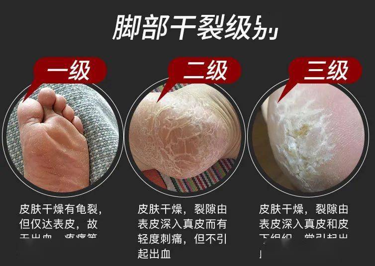 草本植物脚跟开裂、老茧、死皮……又疼又丑！用它一抹，双脚嫩滑，实测惊呆了！