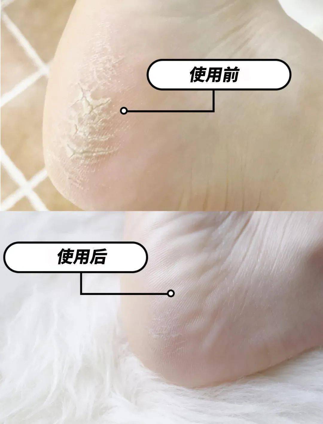 草本植物脚跟开裂、老茧、死皮……又疼又丑！用它一抹，双脚嫩滑，实测惊呆了！