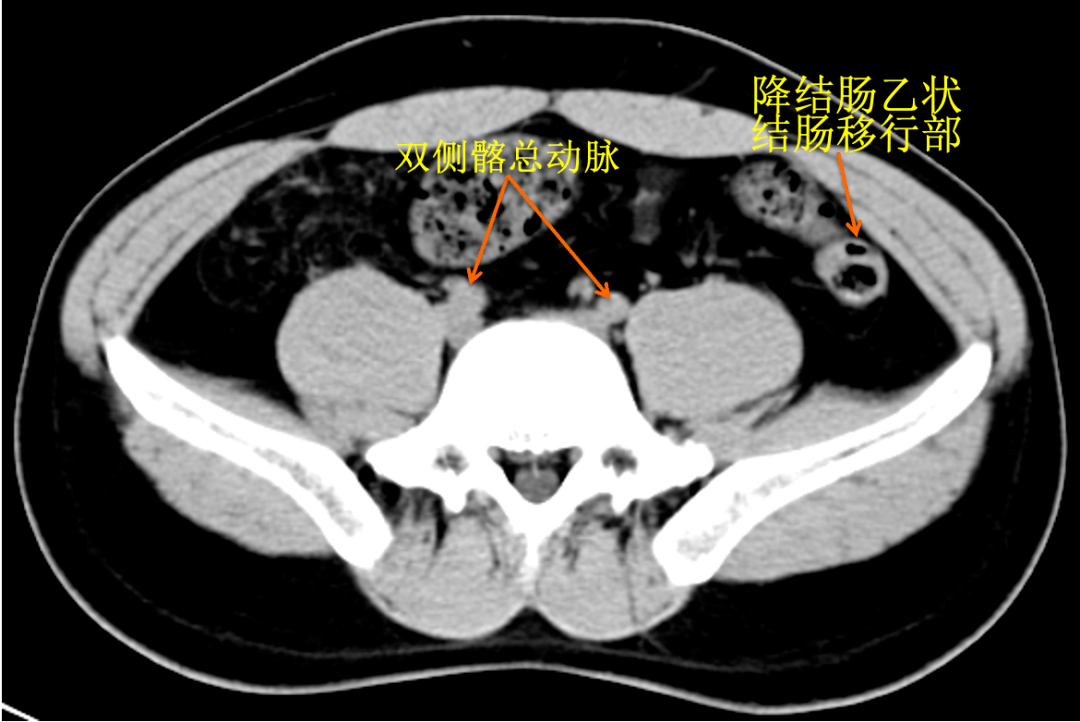 raus專欄|經腰手術體表標誌05_定位_解剖_最高點