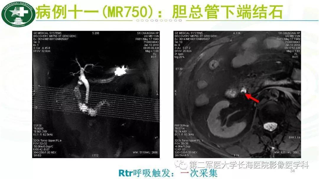 胆总管mri解剖图图片