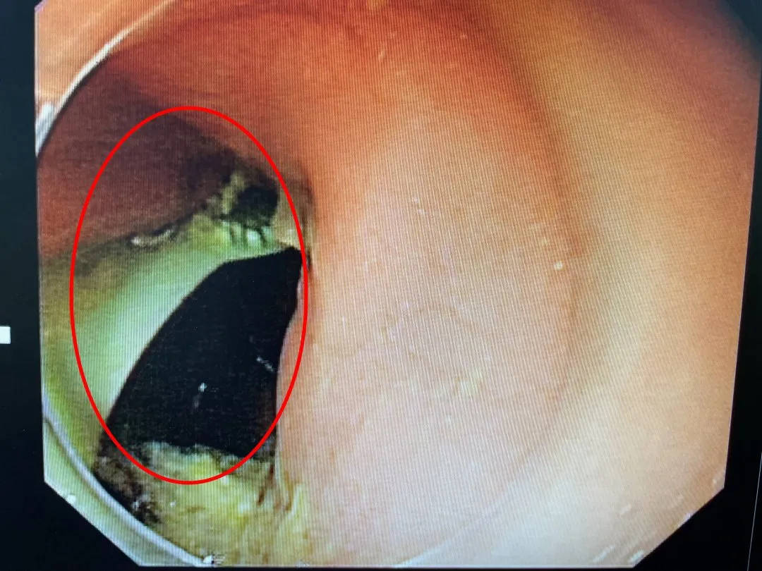 浙江一女子刷完牙漱口,整支牙刷竟掉进胃里_女子刷牙时牙刷滑进胃里