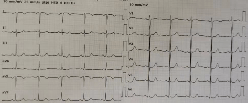 i 導聯中 p,qrs 波,t 波均向下倒置,而且 ii,iii,avr 與 avl 導聯心電