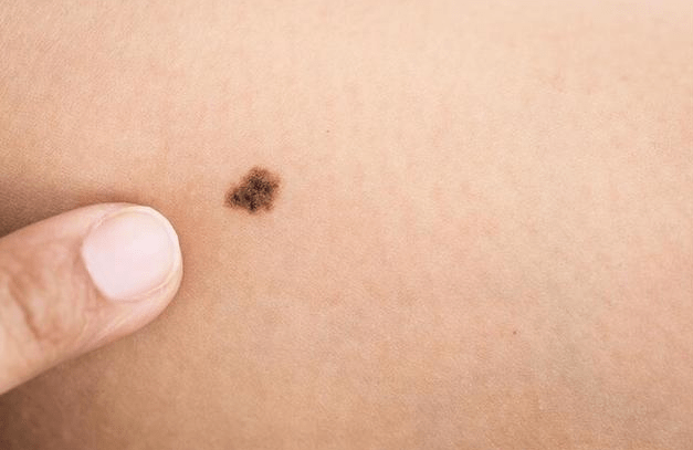 深圳一女子脚底下长了一颗黑痣,却会转移遍布满右腿,像一串串的葡萄