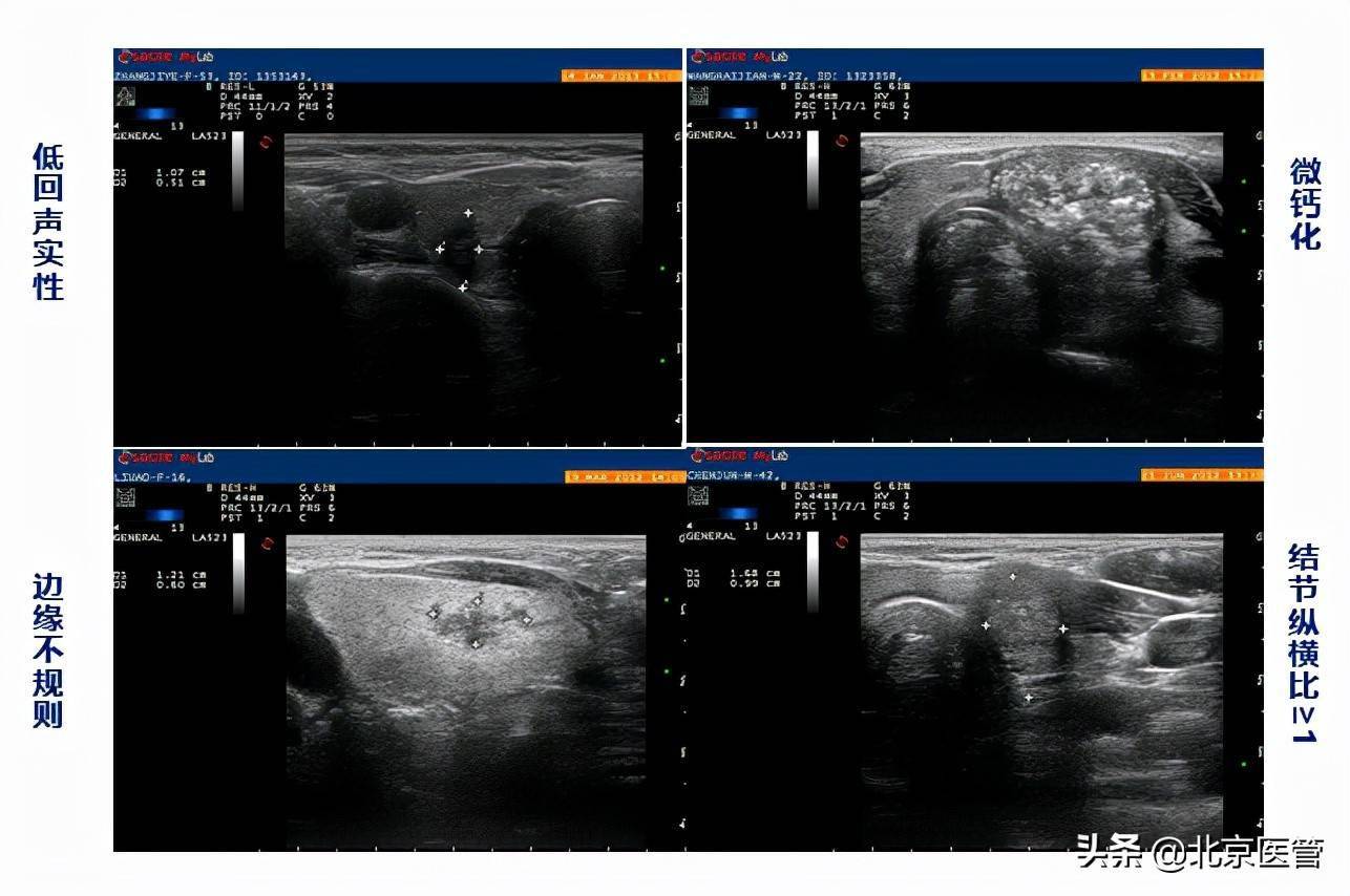 甲状腺b超报告单图片