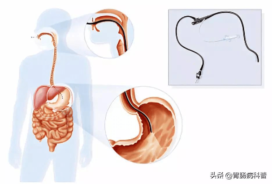 低级别管状腺瘤1级怎么办