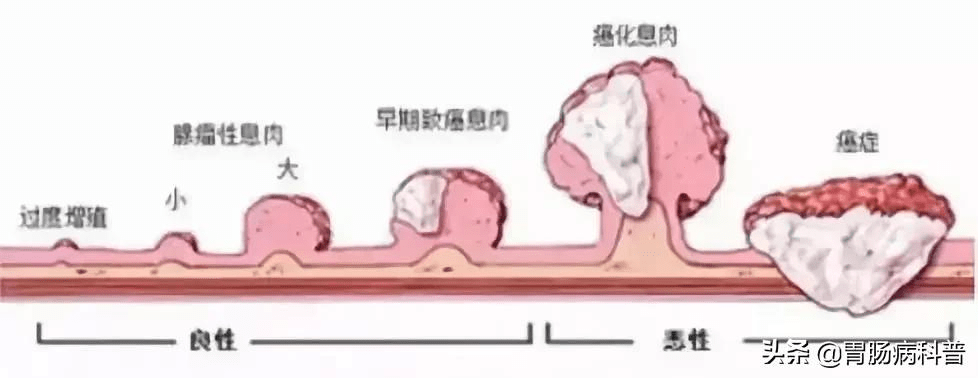 低级别管状腺瘤1级怎么办