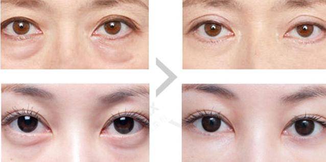 开眼角显老怎么办 cb070cd61ab0442c93a50f20b6c51cc5.jpeg