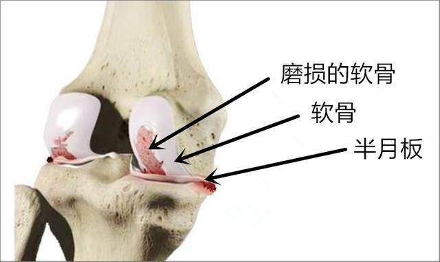 关节软骨的位置图片