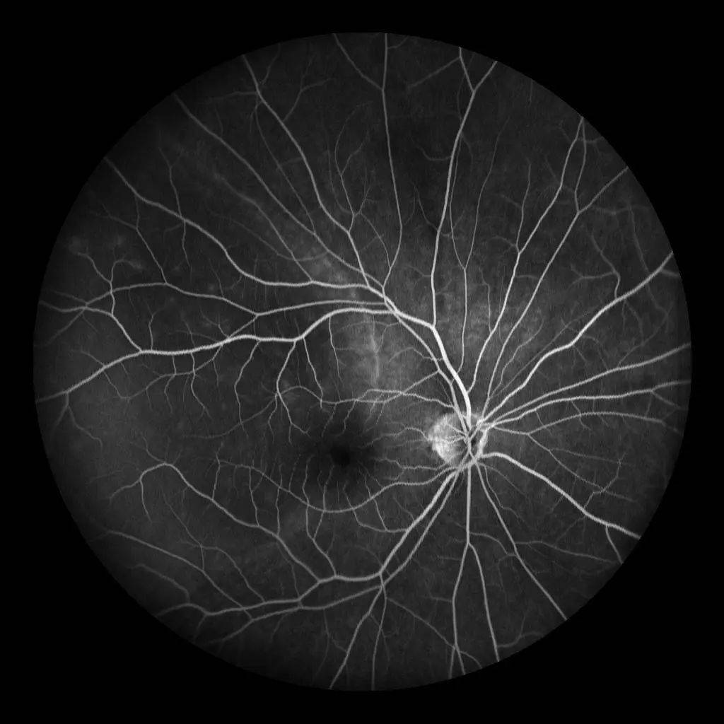 视网膜脱落可以治愈吗(具体有哪些症状？并发症有哪些？) | 说明书网