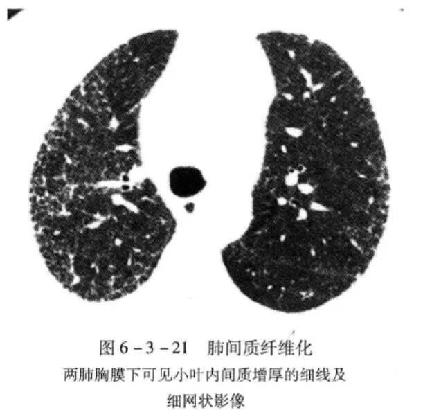【影像笔记】弥漫性肺间质病变的ct基本表现