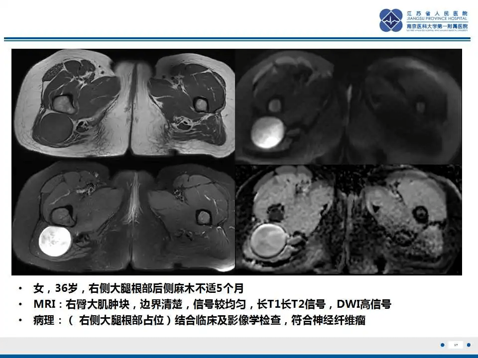 结节性筋膜炎影像表现