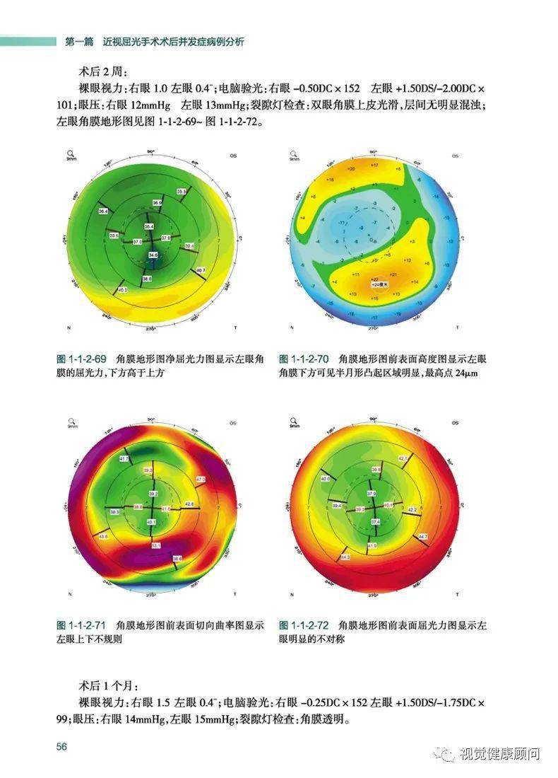 《近视矫治相关并发症病例图解与诊疗思维》_角膜_晶状体_屈光