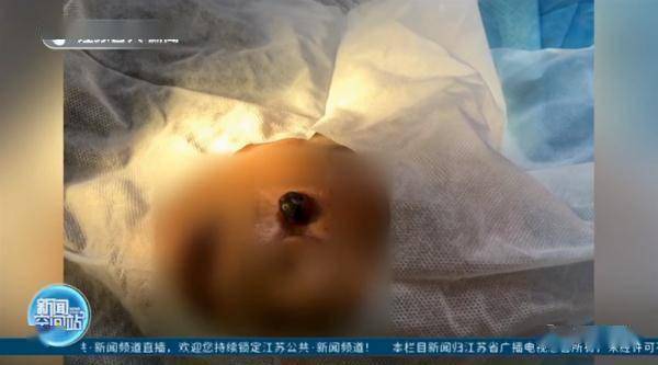 汪乐萍|男子脸上痣突然增大，一查竟是癌！这些部位有痣的人要注意！