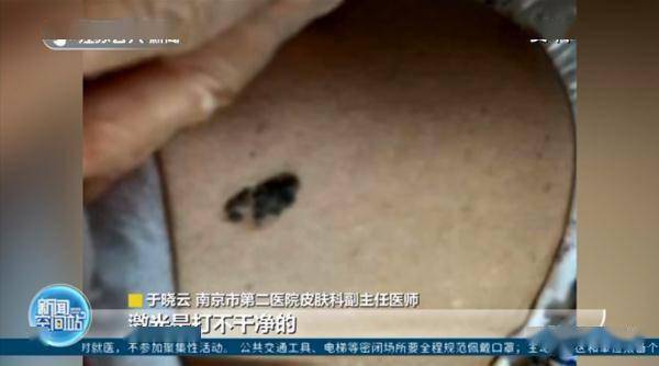 汪乐萍|男子脸上痣突然增大，一查竟是癌！这些部位有痣的人要注意！