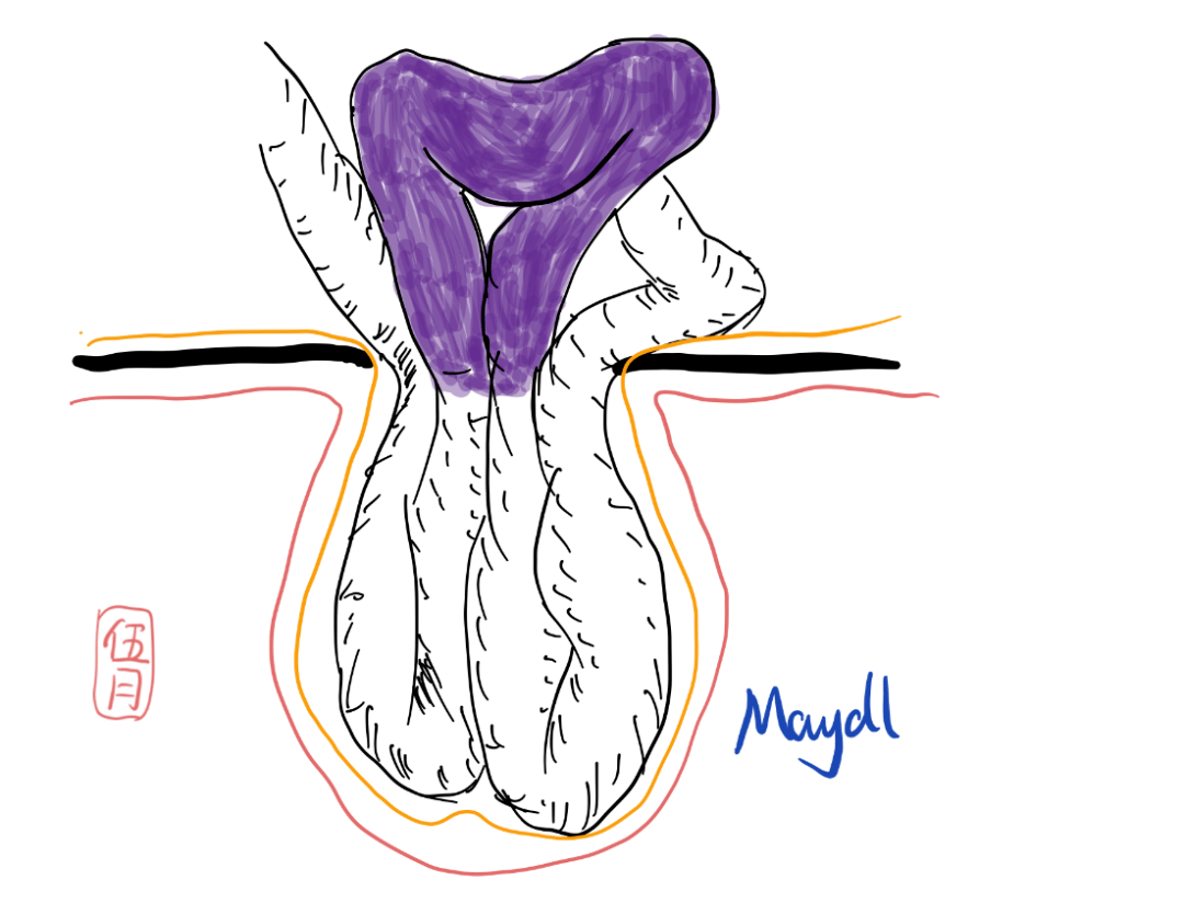 maydl 疝:即逆行性疝,内容物为小肠,疝囊中可有多个肠袢,而位于各嵌顿