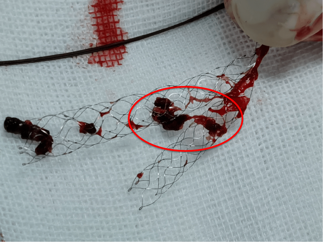 【 卒中美学馆丨ais洞鉴】swim技术双支架大负荷取栓一例_血栓_造影