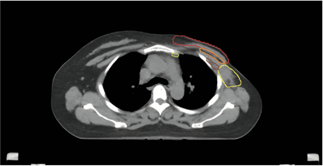 内乳淋巴结靶区勾画图片