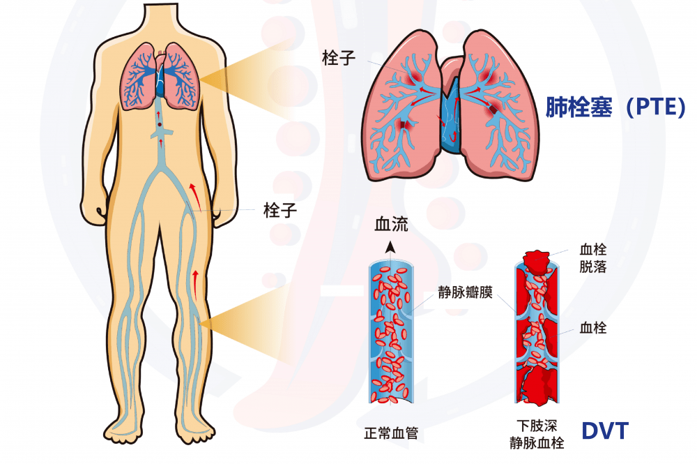 广州市第一人民医院荣获广东省肺栓塞和深静脉血栓防治联盟血栓日