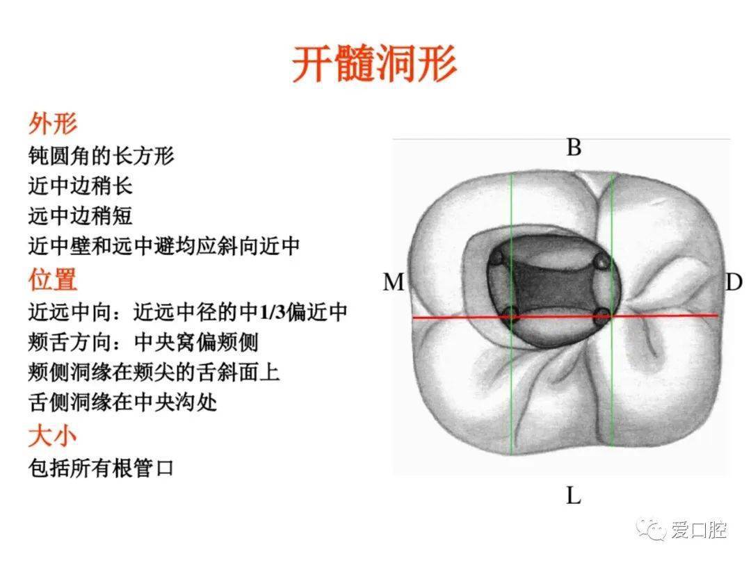 下颌六的开髓形态图片图片