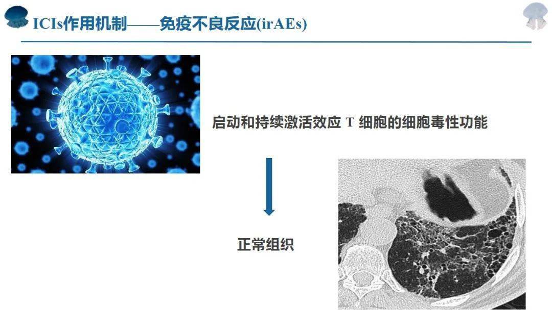 免疫檢查點抑制劑相關肺炎臨床與影像