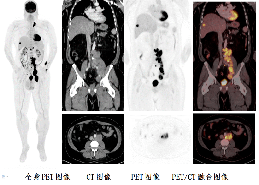 圖中該淋巴瘤患者,通過全身pet/ct掃描,明確病變範圍侵犯到了腹部和